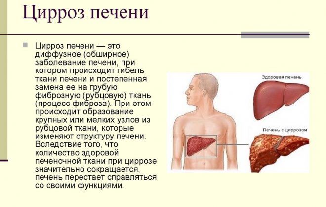 Цирроз печени