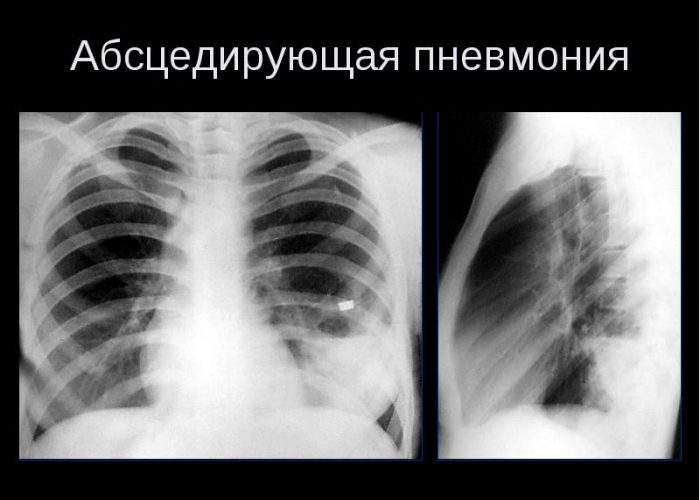 Абсцедирующая пневмония