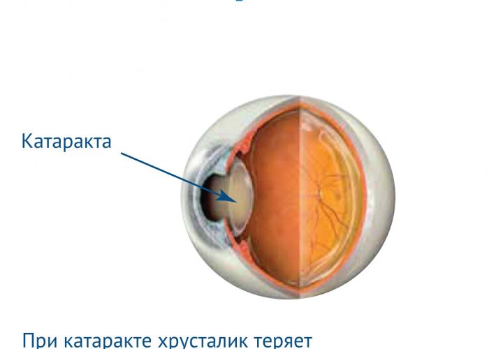 Риск развития катаракты