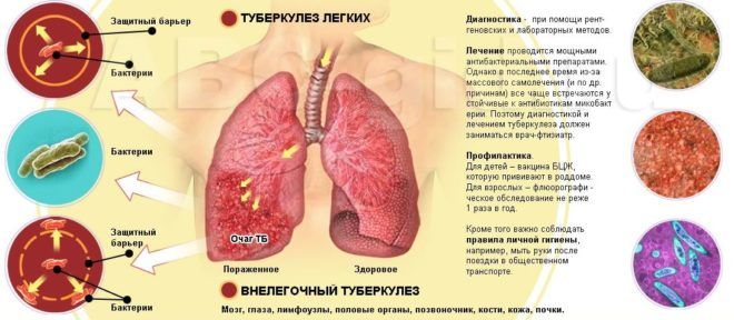 Туберкулез является осложнение пневмофиброза 