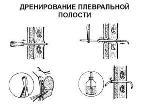 Дренирование плевральной полости