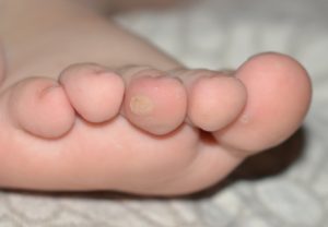 папилломы на пальцах ног у детей