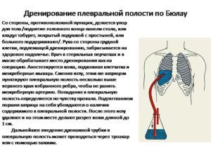 Плевральное дренирование по Бюлау